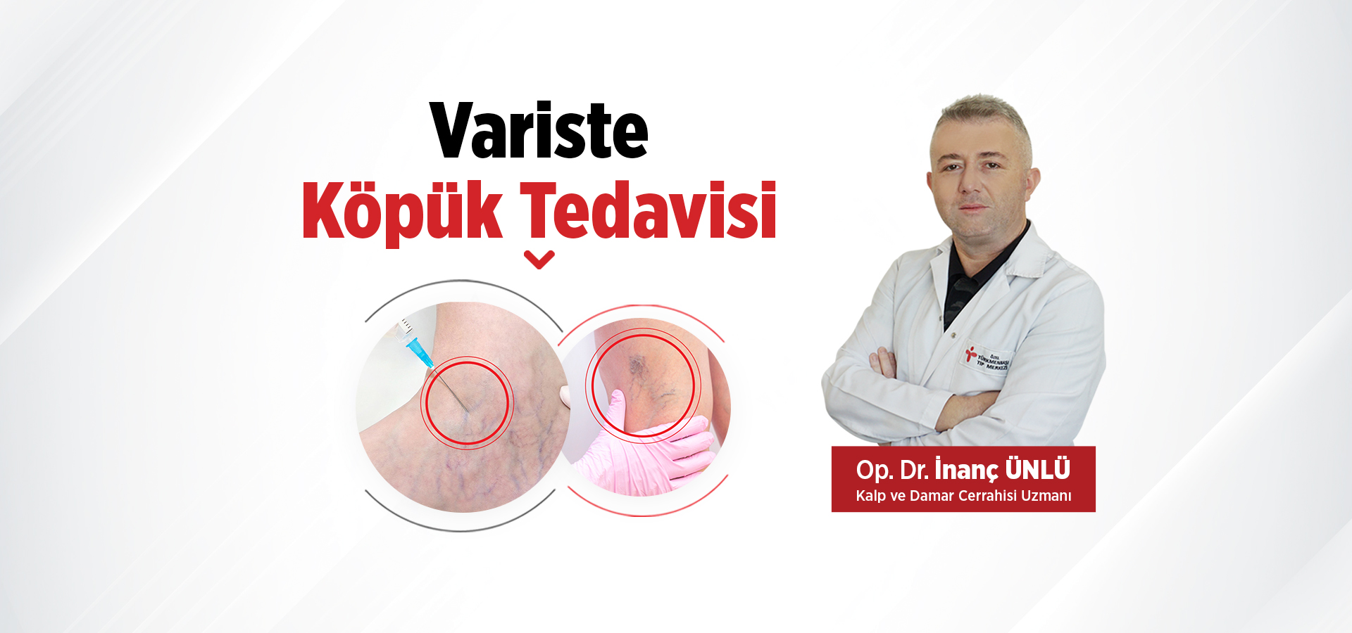 Variste Köpük Tedavisi